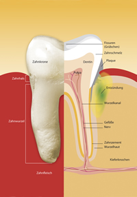 zahnwurzel paradontitis
